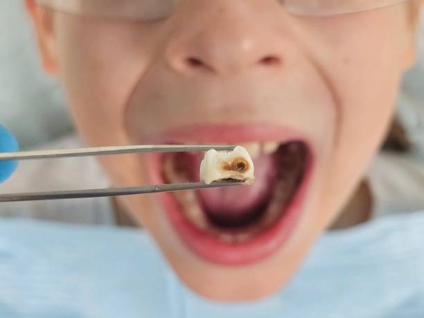 Best Emergency Treatment for Oral Infections in Tomball, TX